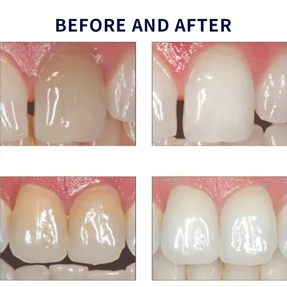 家庭用UV患者セット,プロの衛生機器,紫外線,16%,歯科材 - Teeth Whitening In Office のレビューと価格