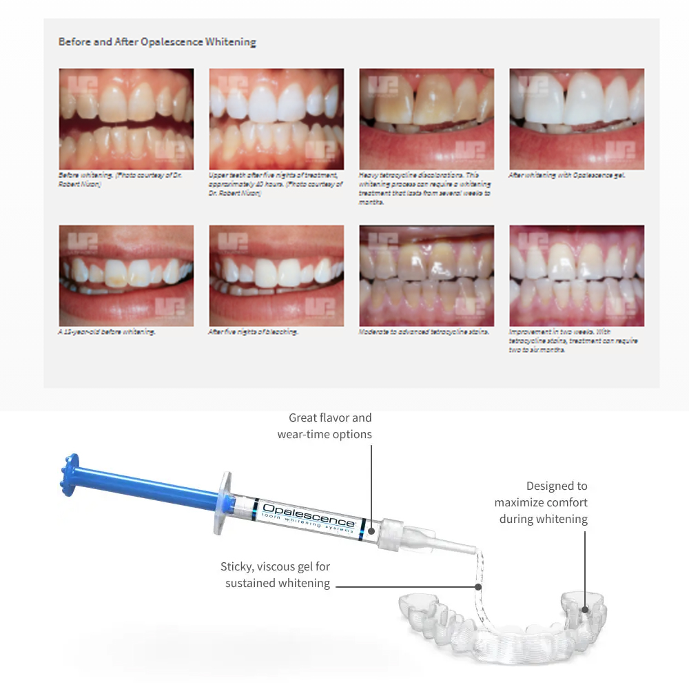 家庭用UV患者セット,プロの衛生機器,紫外線,16%,歯科材 - Teeth Whitening In Office のレビューと価格